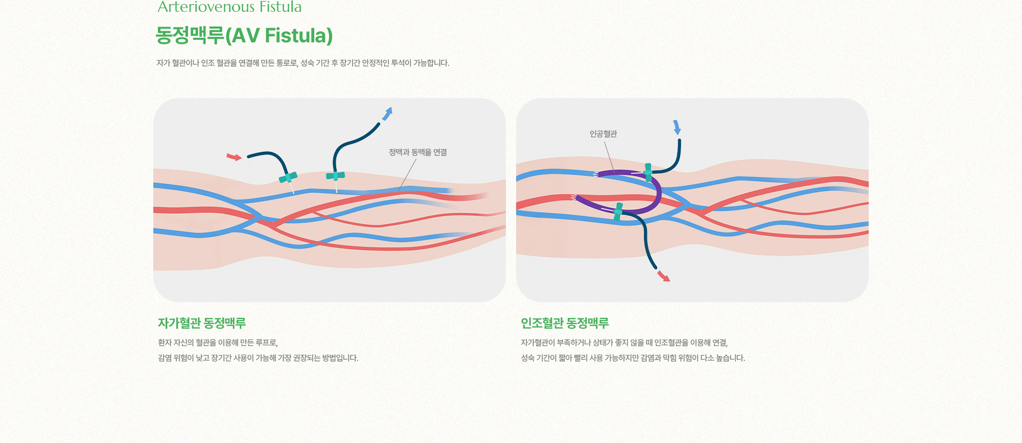 동정맥루(AV Fistula) | 자가 혈관이나 인조 혈관을 연결해 만든 통로로, 성숙 기간 후 장기간 안정적인 투석이 가능합니다. 자가혈관 동정맥루, 인조혈관 동정맥루